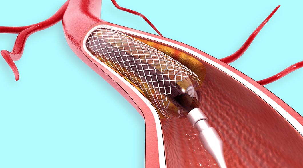 O Que é A Angioplastia Coronária Cardio 365º O Que é A Angioplastia Coronária Cardio 365º